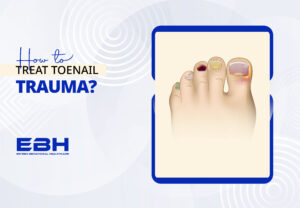 How to Treat Toenail Trauma